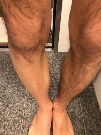 リンクス体験レポ 全身脱毛は効果あるのか 本当に痛くないのか 実際に検証してみた Smartlog リンクス体験レポ 全身脱毛は効果あるのか 本当に痛くないのか 実際に検証してみた Smartlog