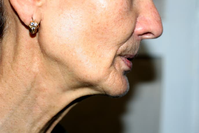 顔のたるみを取る方法 たるむ原因 改善するエクササイズメニューを解説 Smartlog