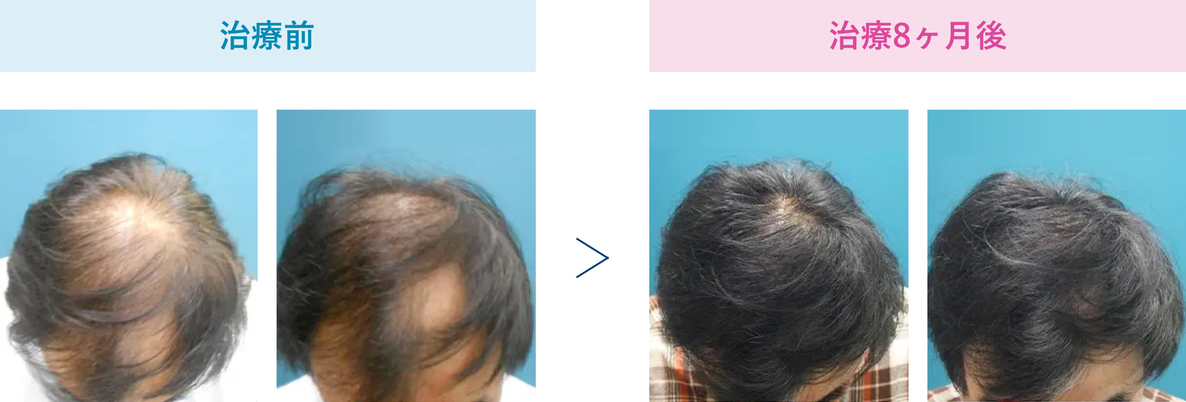 東京のおすすめagaクリニック12選 安い薄毛治療が人気の病院とは Smartlog