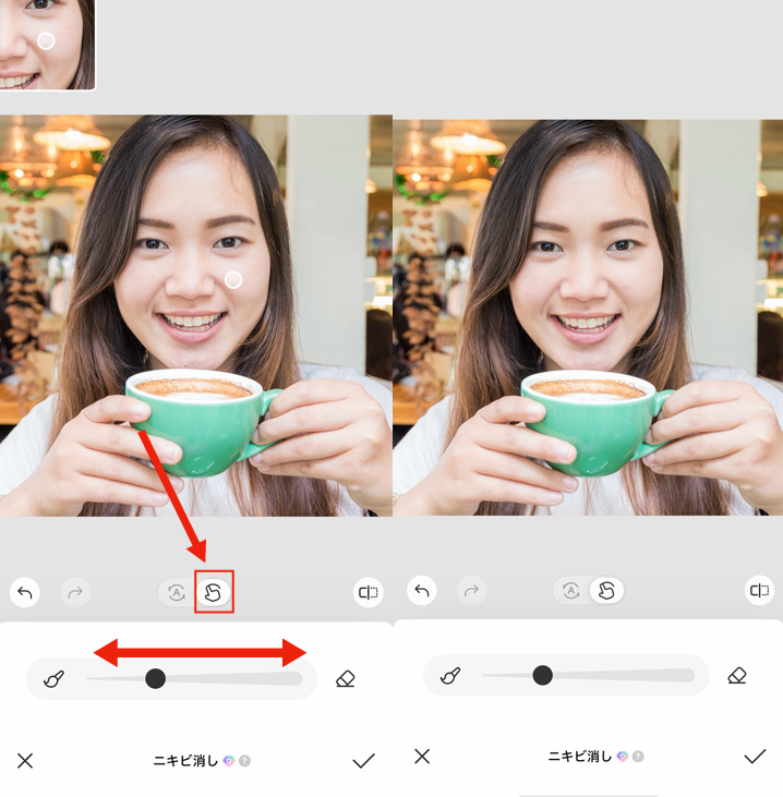 ほくろを消す方法③