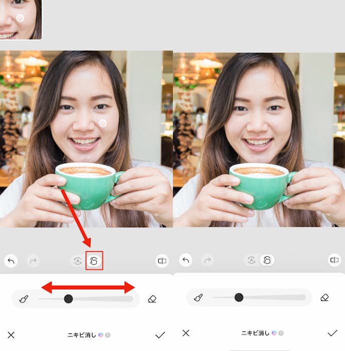 ほくろを消す方法③
