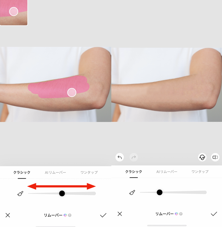 ムダ毛を消す方法③